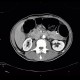 Small cell lung carcinoma, SCLC, metastasis in pancreas: CT - Computed tomography